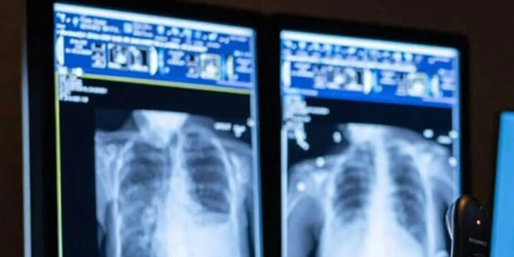 රජයේ රෝහල්වල විකිරණ තාක්ෂණවේදීන්ගේ හිඟයක්