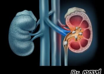 වකුගඩුවේ ගල් හැදෙන්න කලින් මේ ගැනත් දැනගන්න