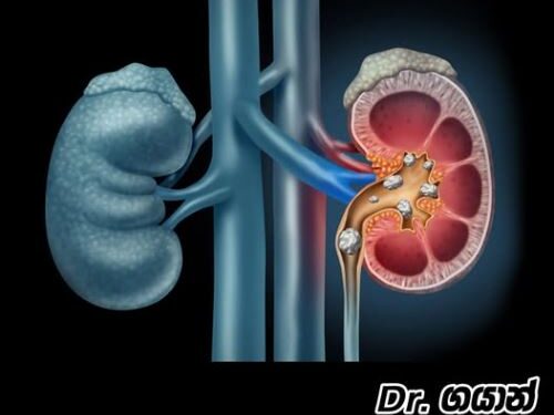 වකුගඩුවේ ගල් හැදෙන්න කලින් මේ ගැනත් දැනගන්න