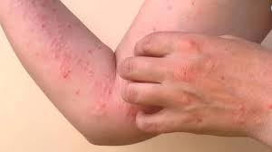 චිකන්ගුන්යා සීඝ්රයෙන් පැතිරීමේ අවදානමක්