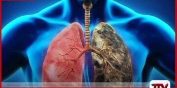 මෙරට ක්ෂය රෝගීන්ගෙන් 45%ක්ම  බස්නාහිර පළාතෙන්  කොළඹ ප්‍රදේශ කිහිපයක් අවදානම්  කලාප ලෙස හඳුනා ගැනේ