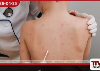 සරම්ප රෝගය  යළි මතුවෙයි