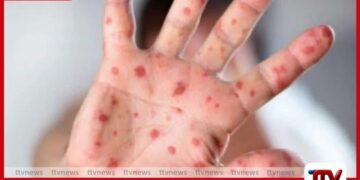 සරම්ප රෝගය සැක සහිත නම්  වහාම වාර්තා කරන ලෙස  සෞඛ්‍ය අංශවලින් විශේෂ දැනුම්දීමක්