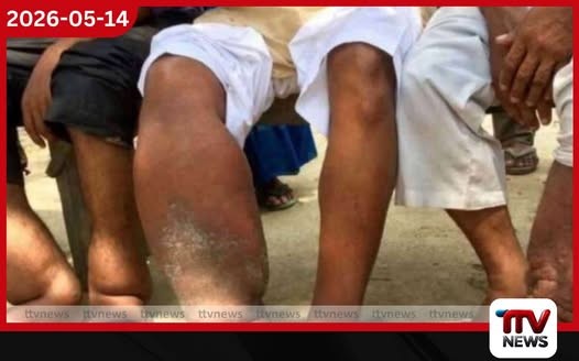 මෙරටින් බරවා රෝගීන් 68 ක් හඳුනාගැනේ