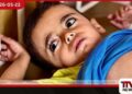 ගාසා තීරයේ අවතැන් කඳවුරුවල  දරුණු චර්ම රෝග ව්‍යාප්තියක්  වින්දිතයන්ගෙන්  බහුතරය කුඩා ළමුන්