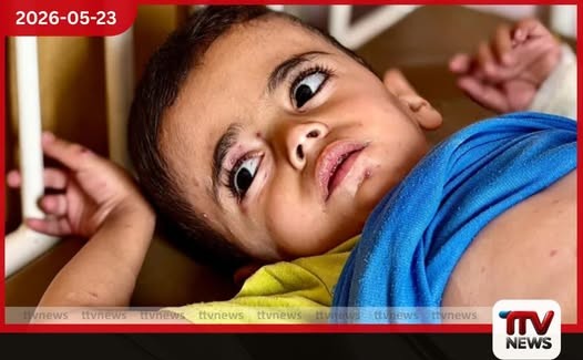 ගාසා තීරයේ අවතැන් කඳවුරුවල දරුණු චර්ම රෝග ව්යාප්තියක් වින්දිතයන්ගෙන් බහුතරය කුඩා ළමුන්