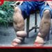 බරවා රෝගය පිළිබඳ  සෞඛ්‍ය අංශවලින්  විශේෂ අනතුරු ඇඟවීමක්