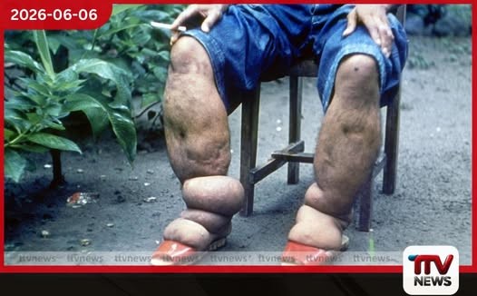 බරවා රෝගය පිළිබඳ සෞඛ්ය අංශවලින් විශේෂ අනතුරු ඇඟවීමක්