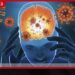 මෙනින්ජයිටීස් රෝග ව්‍යාප්තිය මේ වන විට බොහෝ දුරට පාලනය වෙලා