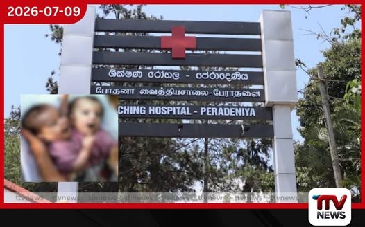 ලොව පළමු වතාවට බද්ධ නිවුන් දරුවන්ට වකුගඩුවක් බද්ධ කර වෙන් කළ විස්මිත සැත්කම පේරාදෙණිය රෝහලෙන් සාර්ථකයි!