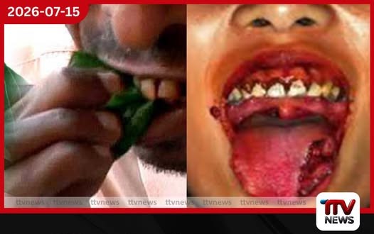 මුඛ පිළිකාවෙන් දිනකට මරණ 3ක්…