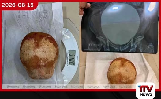 ලෝක වාර්තාවක් අලුත් කරමින් ත්රිකුණාමලයෙන් කිලෝ 3ක් වූ ලොව බරම වකුගඩු ගල ඉවත් කරයි!