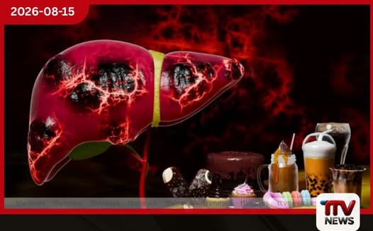 අක්මාවේ මේදය තැන්පත් වීම ඇල්කොහොල් නොබොන අයටත් හැදෙනවා!