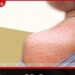 ඇමෙරිකානු CDC ආයතනය සහ පෙනිසිල්වේනියා ප්‍රාන්තය අතර සරම්ප මරණ ගැන දැවැන්ත ගැටුමක්