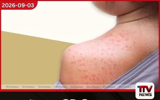 ඇමෙරිකානු CDC ආයතනය සහ පෙනිසිල්වේනියා ප්රාන්තය අතර සරම්ප මරණ ගැන දැවැන්ත ගැටුමක්